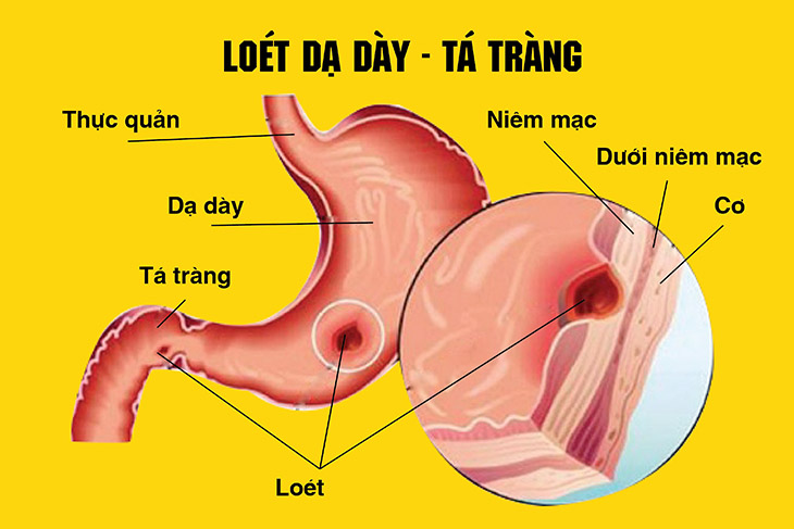 Viêm loét dạ dày tá tràng: nguyên nhân, triệu chứng và chẩn đoán